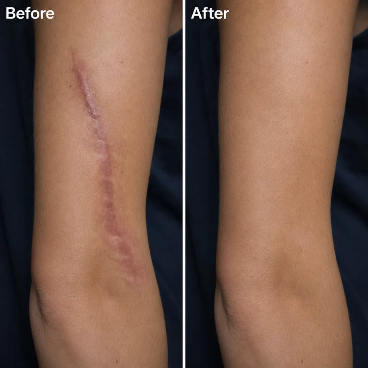 🔥 Advanced Silicone Scar & Wrinkle Smoothing Gel
