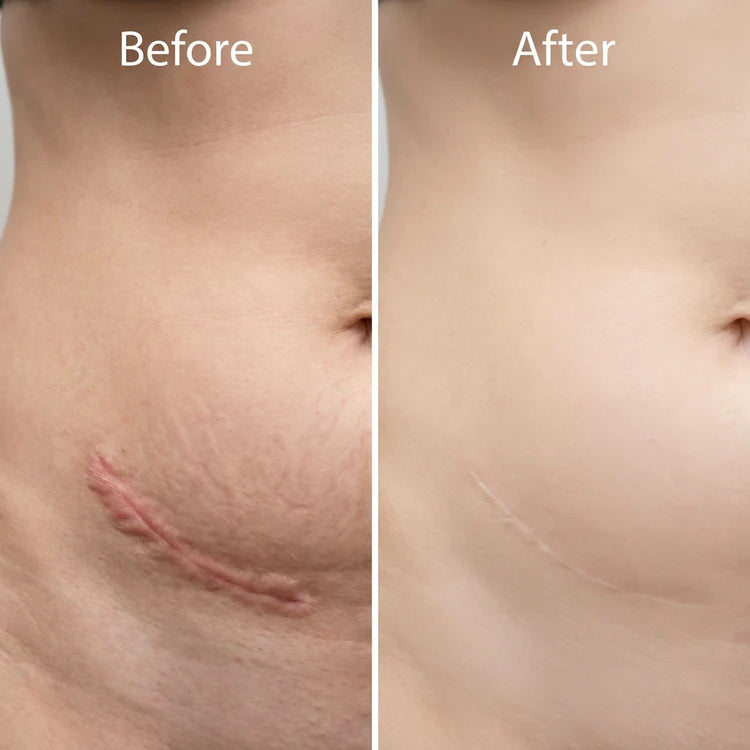 🔥 Advanced Silicone Scar & Wrinkle Smoothing Gel