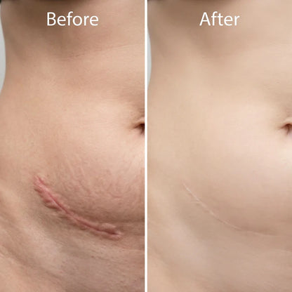 🔥 Advanced Silicone Scar & Wrinkle Smoothing Gel