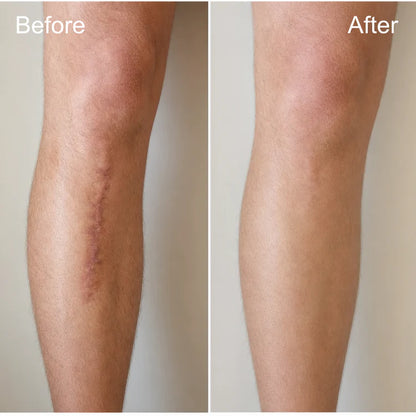 🔥 Advanced Silicone Scar & Wrinkle Smoothing Gel